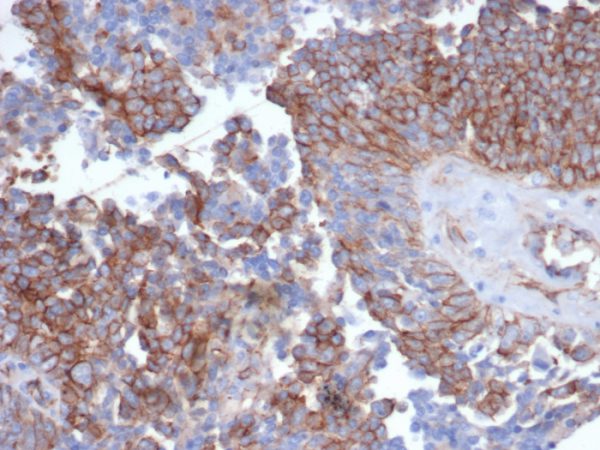 Formalin-fixed, paraffin-embedded human ovarian carcinoma stained with N-Cadherin Recombinant Rabbit Monoclonal Antibody (CDH2/6857R).