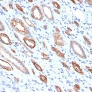 Formalin-fixed, paraffin-embedded human Renal Cell Carcinoma stained with Occludin Mouse Monoclonal Antibody (OCLN/2181).