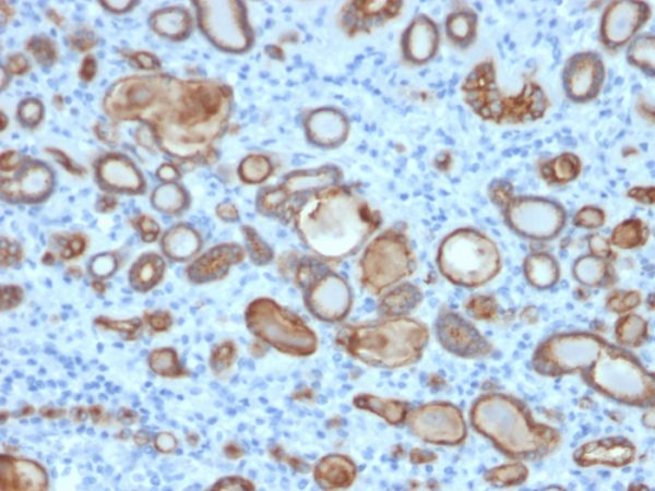 Formalin-fixed, paraffin-embedded human thyroid carcinoma stained with Occludin Mouse Monoclonal Antibody (OCLN/2181).
