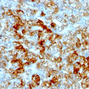 Formalin-fixed, paraffin-embedded human Renal Cell Carcinoma stained with KSP-Cadherin Mouse Monoclonal Antibody (SPM594).