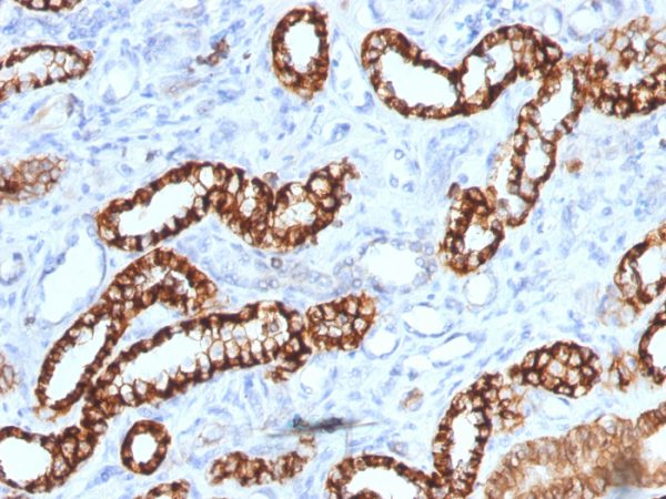 Formalin-fixed, paraffin-embedded human Renal Cell Carcinoma stained with KSP-Cadherin Recombinant Mouse Monoclonal Antibody (rCDH16/1071).
