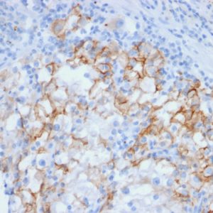 Formalin-fixed, paraffin-embedded human Renal Cell Carcinoma stained with Cadherin 16 Mouse Monoclonal Antibody (CDH16/2448).
