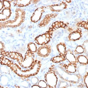 Formalin-fixed, paraffin-embedded human Renal Cell Carcinoma stained with KSP-Cadherin Rabbit Recombinant Monoclonal Antibody (CDH16/1532R)