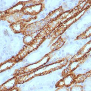 Formalin-fixed, paraffin-embedded Human Renal Cell Carcinoma Stained with KSP-Cadherin Rabbit Polyclonal Antibody.