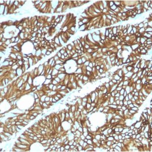 Formalin-fixed, paraffin-embedded human Colon stained with CDH17-Monospecific Mouse Monoclonal Antibody (CDH17/2615).