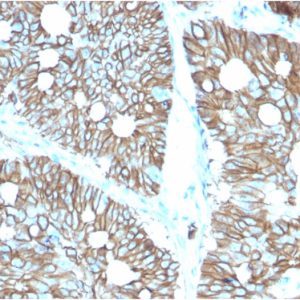 Formalin-fixed, paraffin-embedded human Colon stained with Cadherin 17 / CDH17 Mouse Monoclonal Antibody (CDH17/2616).