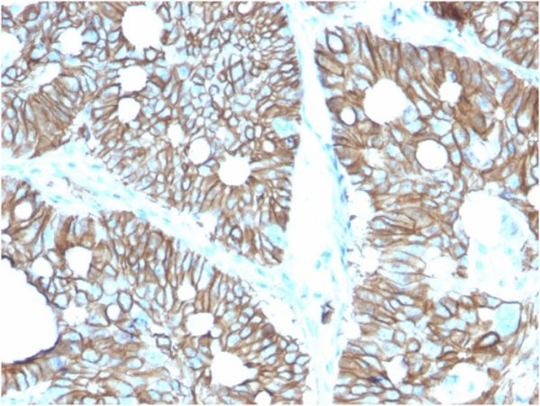 Formalin-fixed, paraffin-embedded human Colon stained with Cadherin 17 / CDH17 Mouse Monoclonal Antibody (CDH17/2616).