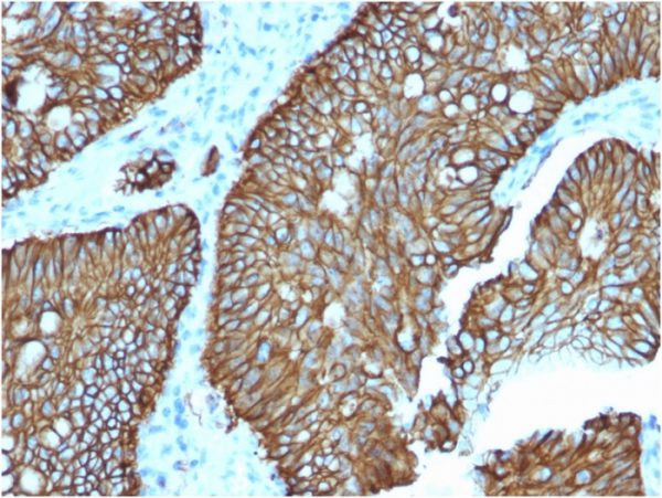 Formalin-fixed, paraffin-embedded human Colon stained with Cadherin 17 / CDH17 Mouse Monoclonal Antibody (CDH17/2618).