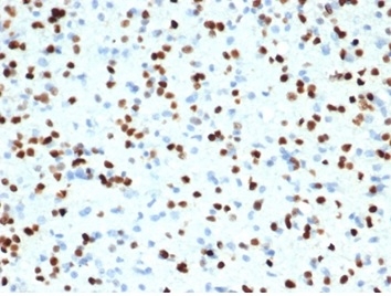 Formalin-fixed, paraffin-embedded human brain stained with OLIG2 Recombinant Rabbit Monoclonal Antibody (OLIG2/7074R).
