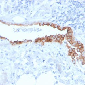 Formalin-fixed, paraffin-embedded human Lung Mesothelioma stained with Mesothelin Mouse Monoclonal Antibody (MSLN/3384).