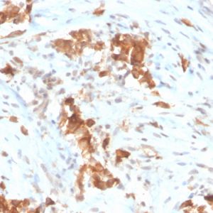 Formalin-fixed, paraffin-embedded human mesothelioma stained with Mesothelin Mouse Monoclonal Antibody (MSLN/3385).