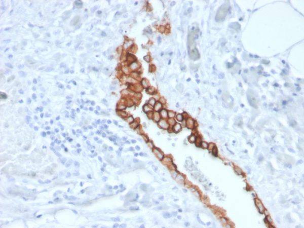 Formalin-fixed, paraffin-embedded human mesothelioma stained with Mesothelin Mouse Monoclonal Antibody (MSLN/3387).