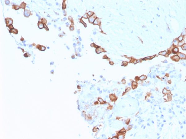 Formalin-fixed, paraffin-embedded human mesothelioma stained with Mesothelin Mouse Monoclonal Antibody (MSLN/3387).