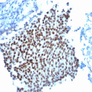 Formalin-fixed, paraffin-embedded Bladder Carcinoma stained with p21 Monoclonal Antibody (WA-1).