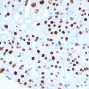 Formalin fixed paraffin embedded human colon carcinoma stained with p21 Recombinant Mouse Monoclonal Antibody (rCIP1/6907) at 2ug/ml. HIER: Tris/EDTA, pH9.0, 45min. 2°C: HRP-polymer, 30min. DAB, 5min.