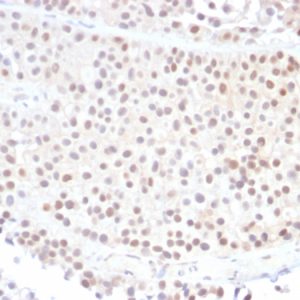 Formalin-fixed, paraffin-embedded human Bladder Carcinoma stained with p21 Mouse Monoclonal Antibody (DCS-60.2).