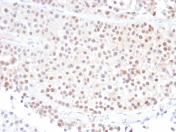 Formalin-fixed, paraffin-embedded human Bladder Carcinoma stained with p21 Mouse Monoclonal Antibody (DCS-60.2).