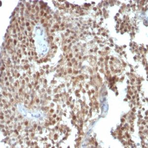 Formalin-fixed, paraffin-embedded human Colon Carcinoma stained with p21 Monoclonal Antibody (SPM306).