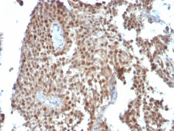 Formalin-fixed, paraffin-embedded human Colon Carcinoma stained with p21 Monoclonal Antibody (SPM306).