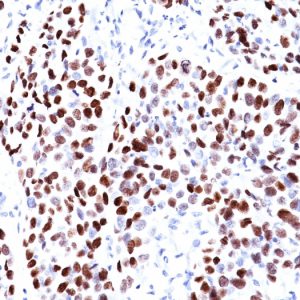 Formalin-fixed, paraffin-embedded human Lung SqCC stained with p21 Mouse Monoclonal Antibody (CIP1/823).