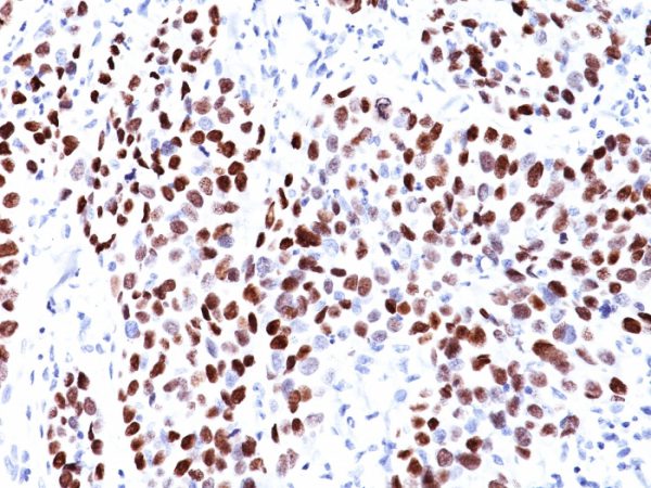 Formalin-fixed, paraffin-embedded human Lung SqCC stained with p21 Mouse Monoclonal Antibody (CIP1/823).