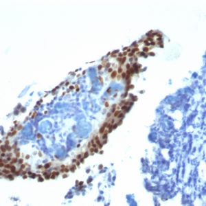 Formalin-fixed, paraffin-embedded Bladder Carcinoma stained with p21 Monoclonal Antibody (HJ21).