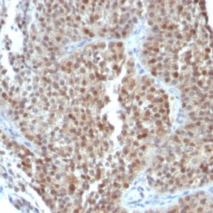 Formalin-fixed, paraffin-embedded human Bladder Carcinoma stained with p21 Mouse Monoclonal Antibody (CIP1/823 + DCS-60.2).