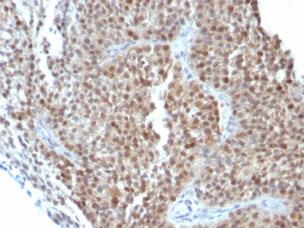 Formalin-fixed, paraffin-embedded human Bladder Carcinoma stained with p21 Mouse Monoclonal Antibody (CIP1/823 + DCS-60.2).