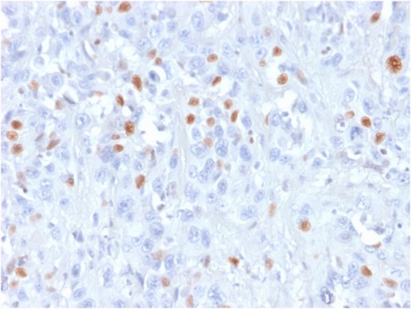 Formalin-fixed, paraffin-embedded human Urothelial carcinoma stained with p21 Mouse Recombinant Monoclonal Antibody (rCIP1/823).