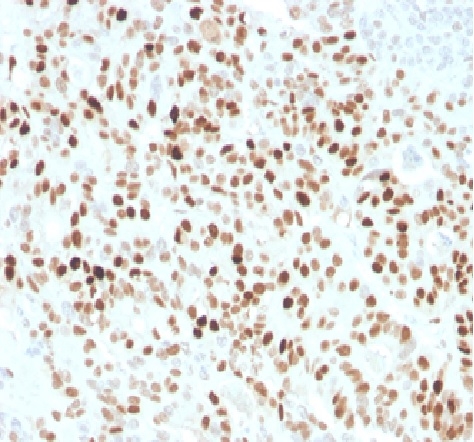 Formalin fixed paraffin embedded human colon carcinoma stained with p21 Rabbit Recombinant Monoclonal Antibody (CIP1/4377R).