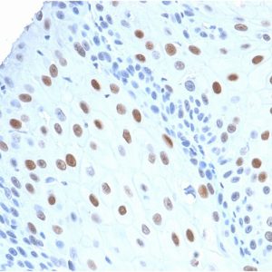 Formalin-fixed, paraffin-embedded human Urothelial Carcinoma stained with p21 Rabbit Recombinant Monoclonal Antibody (CIP1/2275R).