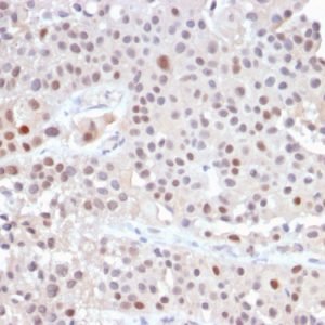 Formalin-fixed, paraffin-embedded human Urothelial Carcinoma stained with p21 Rabbit Recombinant Monoclonal Antibody (CIP1/2489R).