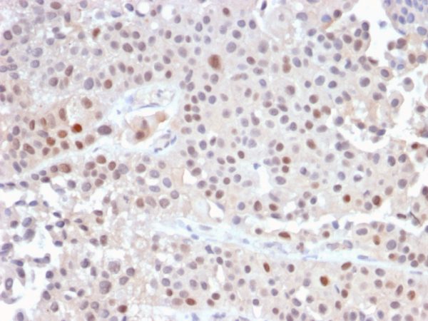 Formalin-fixed, paraffin-embedded human Urothelial Carcinoma stained with p21 Rabbit Recombinant Monoclonal Antibody (CIP1/2489R).