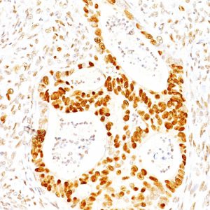 Formalin-fixed, paraffin-embedded human Colon Carcinoma stained with p27 Mouse Monoclonal Antibody (SX53G8).