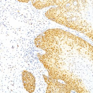 Formalin-fixed, paraffin-embedded human Cervical Carcinoma stained with p27 Mouse Monoclonal Antibody (KIP1/769).