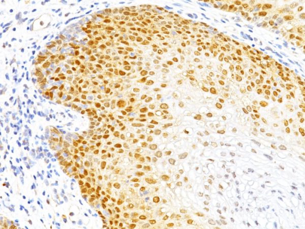 Formalin-fixed, paraffin-embedded human Cervical Cancer stained with p27 Monoclonal Antibody (DCS-72.F6)