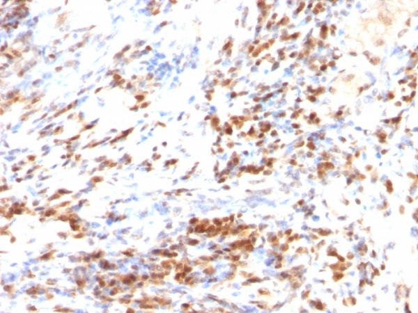 Formalin-fixed, paraffin-embedded human Colon Cancer stained with p27 Monoclonal Antibody (DCS-72.F6 + KIP1/769)