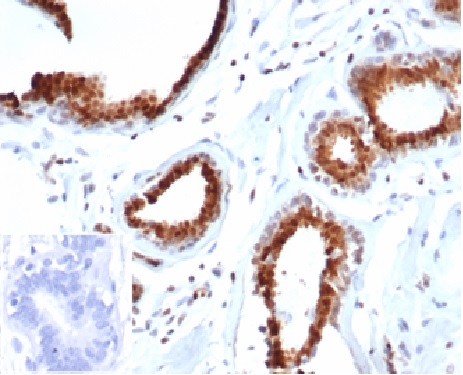 Formalin-fixed, paraffin-embedded human breast carcinoma stained with p27 Recombinant Mouse Monoclonal Antibody (rKIP1/1356). Inset: PBS instead of primary antibody. Secondary negative control.