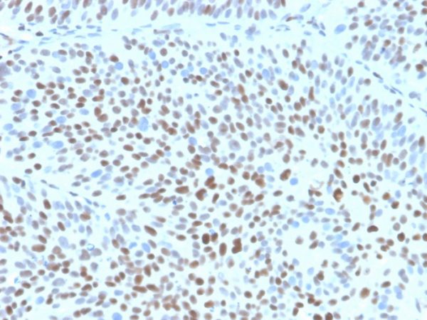 IHC analysis of formalin-fixed, paraffin-embedded human bladder. Strong nuclear staining using KIP1/1355R at 2ug/ml in PBS for 30min RT. HIER: Tris/EDTA, pH9.0, 45min. 2°C: HRP-polymer, 30min. DAB, 5min.