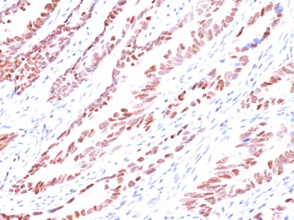 Formalin-fixed, paraffin-embedded human Colon Carcinoma stained with p57 Monoclonal Antibody (KP10).