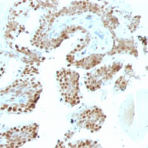 Formalin-fixed, paraffin-embedded human Prostate Carcinoma stained with p57 Mouse Monoclonal Antibody (SPM308).