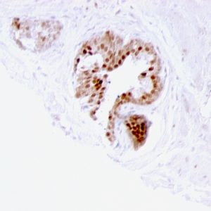 Formalin-fixed, paraffin-embedded human prostate carcinoma stained with p57 Mouse Monoclonal Antibody (57P06).