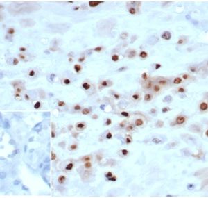 IHC analysis of formalin-fixed, paraffin-embedded human placenta.  Strong nuclear staining using KIP2/7083R at 2ug/ml in PBS for 30min RT. Inset: PBS instead of primary antibody; secondary only negative control.