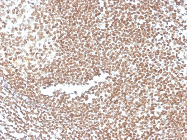 Formalin-fixed, paraffin-embedded human colon stained with P16INK4a Mouse Monoclonal Antibody (CDKN2A/3830).