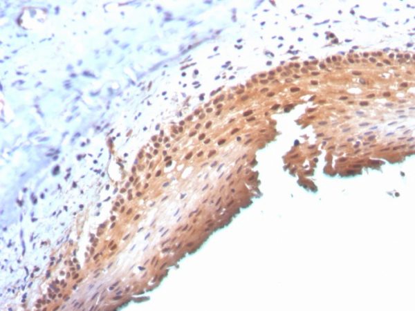 Formalin-fixed, paraffin-embedded human cervix stained with P16INK4a Mouse Monoclonal Antibody (CDKN2A/3830).