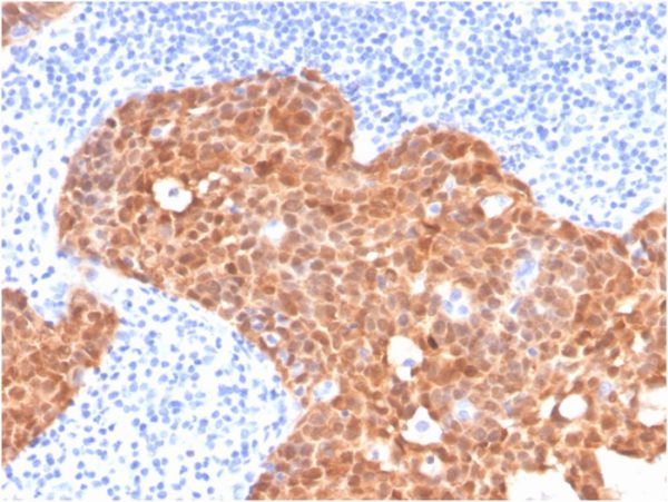Formalin-fixed, paraffin-embedded human cervix stained with P16INK4a Mouse Monoclonal Antibody (CDKN2A/4499).