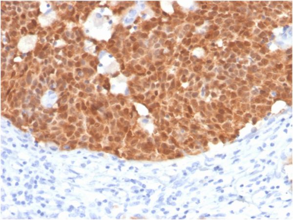 Formalin-fixed, paraffin-embedded human cervix stained with P16INK4a Mouse Monoclonal Antibody (CDKN2A/4499).