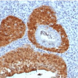 Formalin-fixed, paraffin-embedded human cervix stained with P16INK4a Recombinant Mouse Monoclonal Antibody (rCDKN2A/4845).