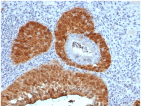 Formalin-fixed, paraffin-embedded human cervix stained with P16INK4aRecombinant Mouse Monoclonal Antibody (rCDKN2A/4845).