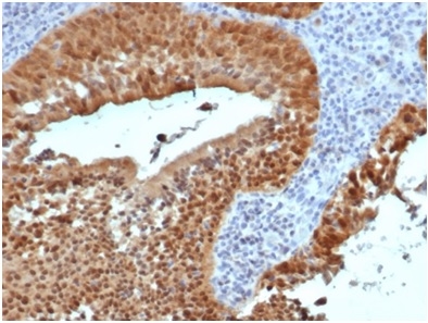 Formalin-fixed, paraffin-embedded human cervix stained with P16INK4aRecombinant Mouse Monoclonal Antibody (rCDKN2A/4845).